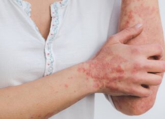 Ce beurre africain vous débarrassera des sécheresses de la peau et du psoriasis Ce beurre africain vous débarrassera des sécheresses de la peau et du psoriasis