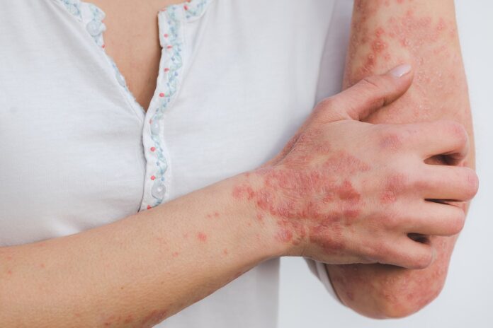 Ce beurre africain vous débarrassera des sécheresses de la peau et du psoriasis