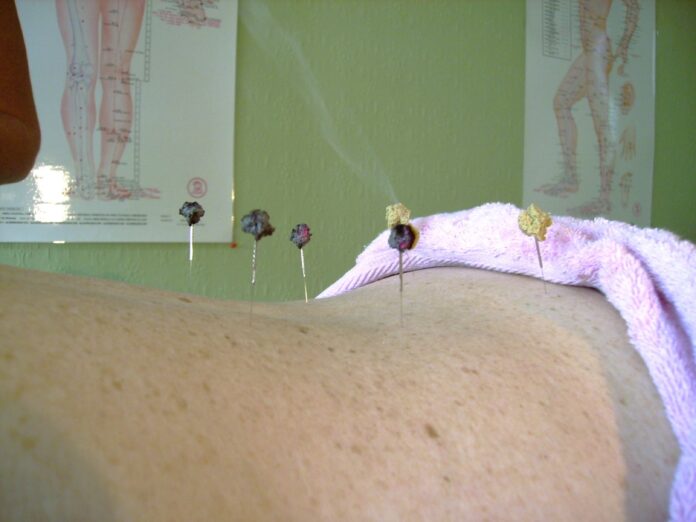 moxibustion