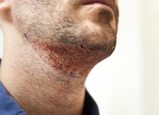 Drame après une greffe de barbe en Turquie Drame après une greffe de barbe en Turquie