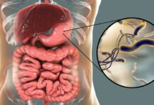 Les méthodes naturelles pour traiter l’Helicobacter Pylori